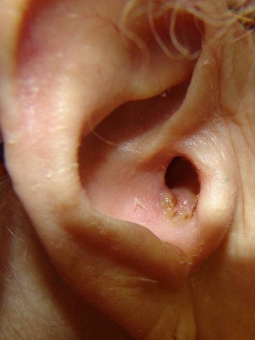 Pilz im Ohr