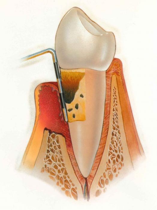 Parodontitis Symptome